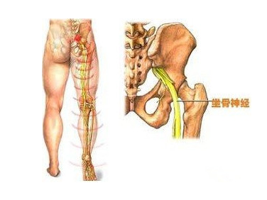 坐骨神经痛